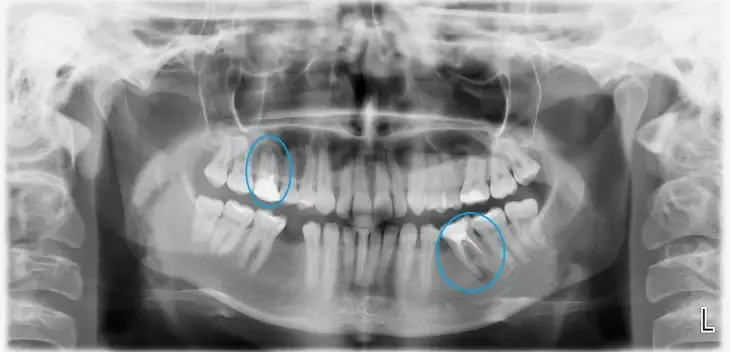 Zmiany okołowierzcholkowe przy zębach po leczeniu kanałowym